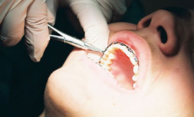 Dentista ajustando un aparato de ortodoncia
